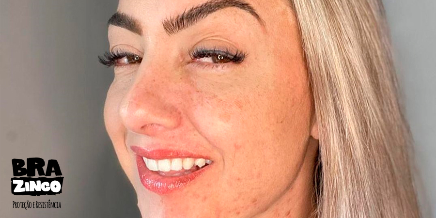 melasma-como-previnir-protetorbrazinco